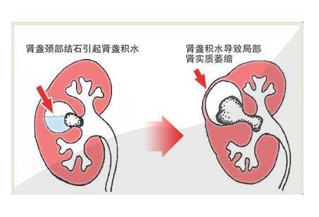 西宁肾结石